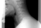 cervical spine g7ecc17af2 1920 Comment traiter des maux de tête liés à une arthrose cervicale ?
